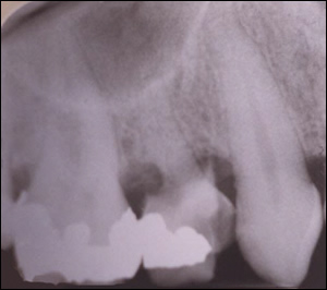 Sinus Augmentation Figure 1