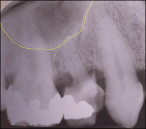 Sinus Augmentation Figure 2