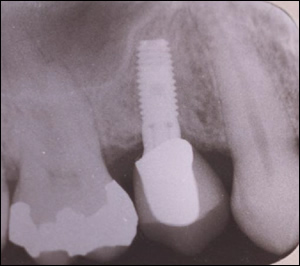 Sinus Augmentation - 1 Figure 3