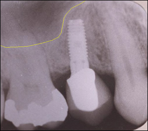 Sinus Augmentation - 1 Figure 4