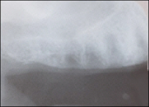 Sinus Augmentation - 2 Figure 1