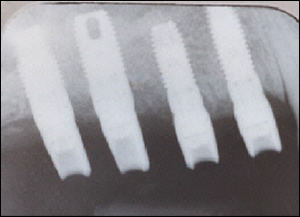 Sinus Augmentation - 2 Figure 3