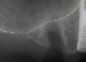 Sinus Augmentation - 3 Figure 2