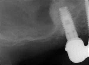 Sinus Augmentation - 3 Figure 3