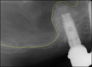 Sinus Augmentation - 3 Figure 4