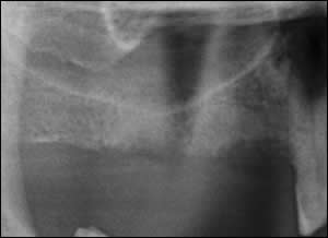 Bone Augmentation