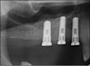 bone augmentation