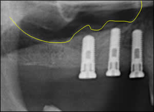bone augmentation