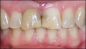 upper crowns