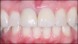 upper crowns