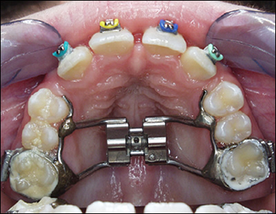 Rapid Palatal Expansion