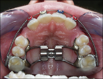 Rapid palatal expansion