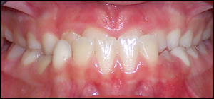 anterior sagittal appliance