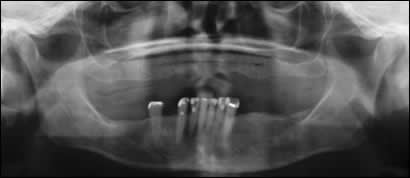 implant