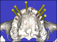 implant