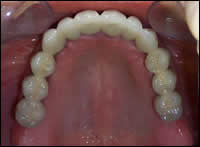 implant