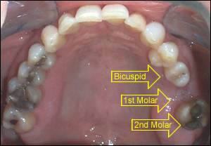 implant
