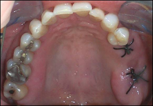 implant