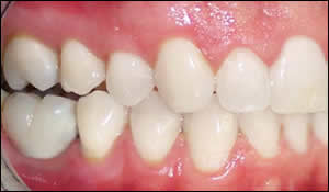 implant