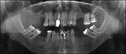 implant