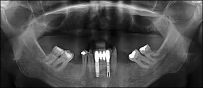 implant