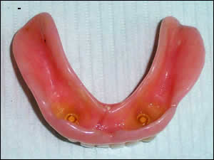 natural overdenture