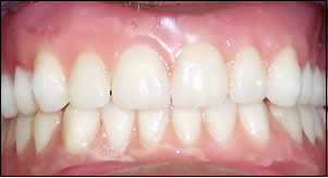 natural overdenture