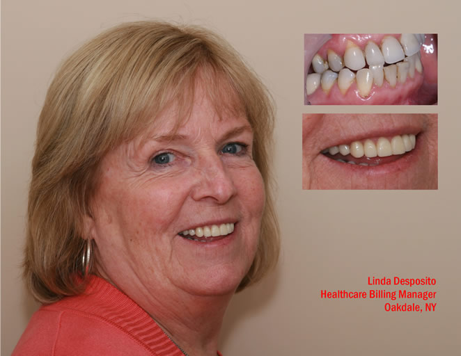 cs veneers 1