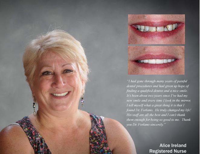 cs veneers 1