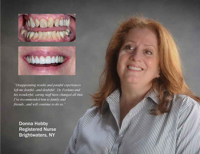 cs veneers 1