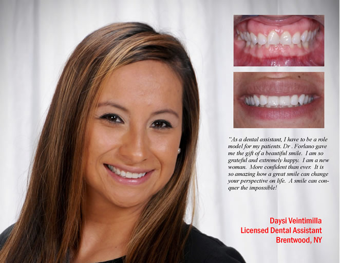 cs veneers 1