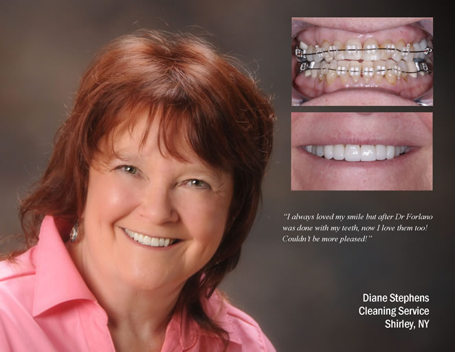 cs veneers 1