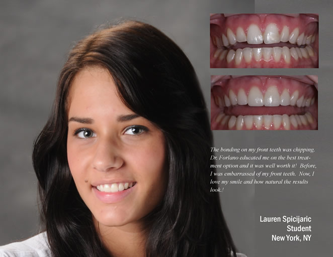 cs veneers 1