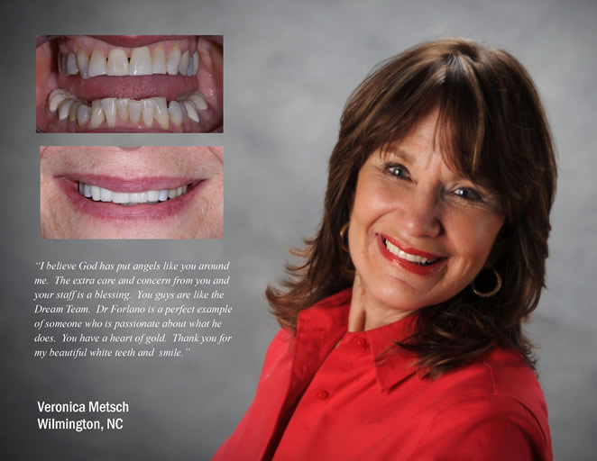 cs veneers 1