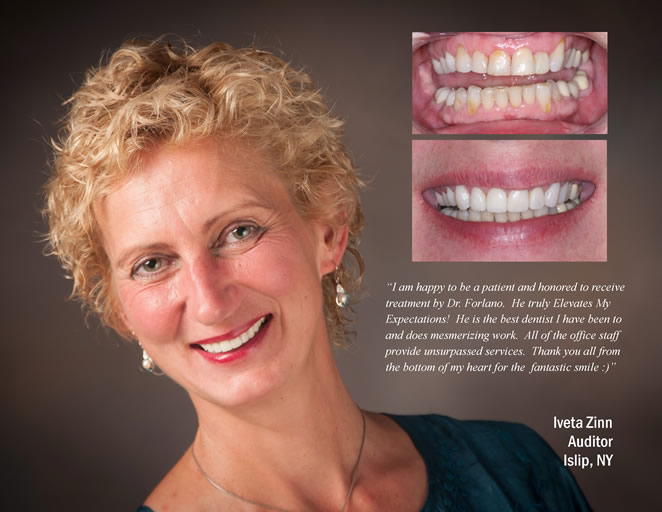 cs veneers 1
