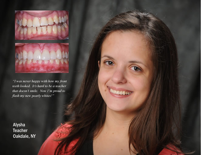 cs veneers 1
