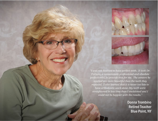 cs veneers 1