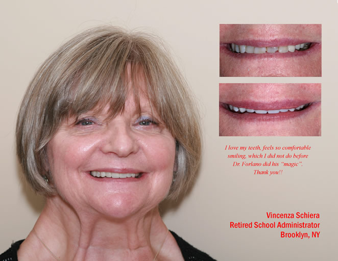 cs veneers 1