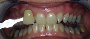 Whitening-1